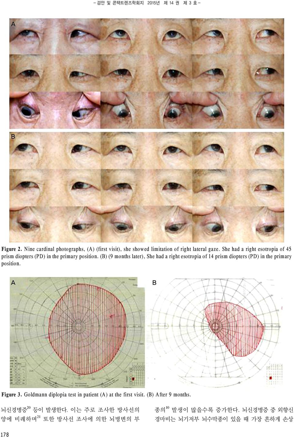 She had a right esotropia of 45 prism diopters (PD) in the primary position.