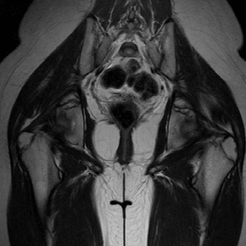 - 대한내과학회지 : 제 72 권부록 2 호 2007 - A B Figure 2. Pelvic MRI findings of the patient. (A) T2 sagittal image of the patient. There is a very small uterus; (b) T2 coronal image of the patient.