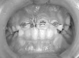 Crown exposure of impacted incisor after 1