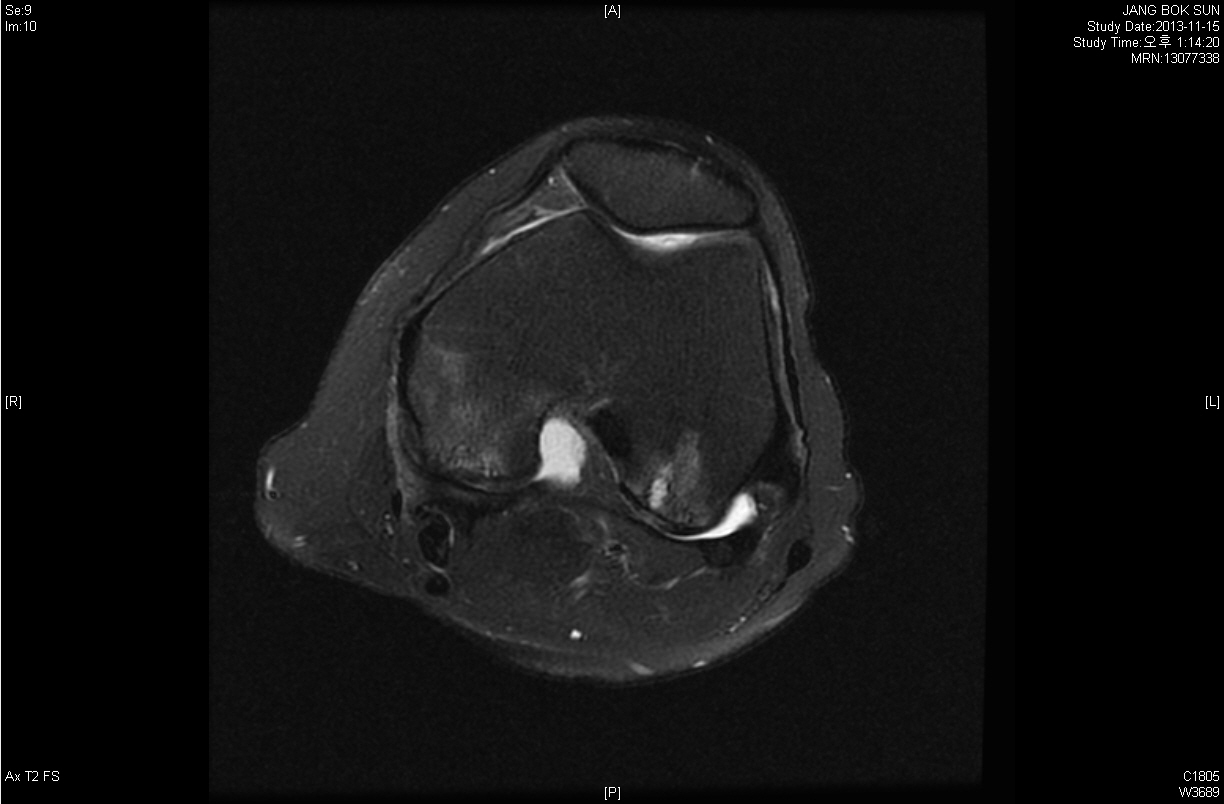 이상욱 양재철 옥소윤 방찬혁 신우석 Fig. 2. MRI Sagittal image showing osteonecrosis of Lt.