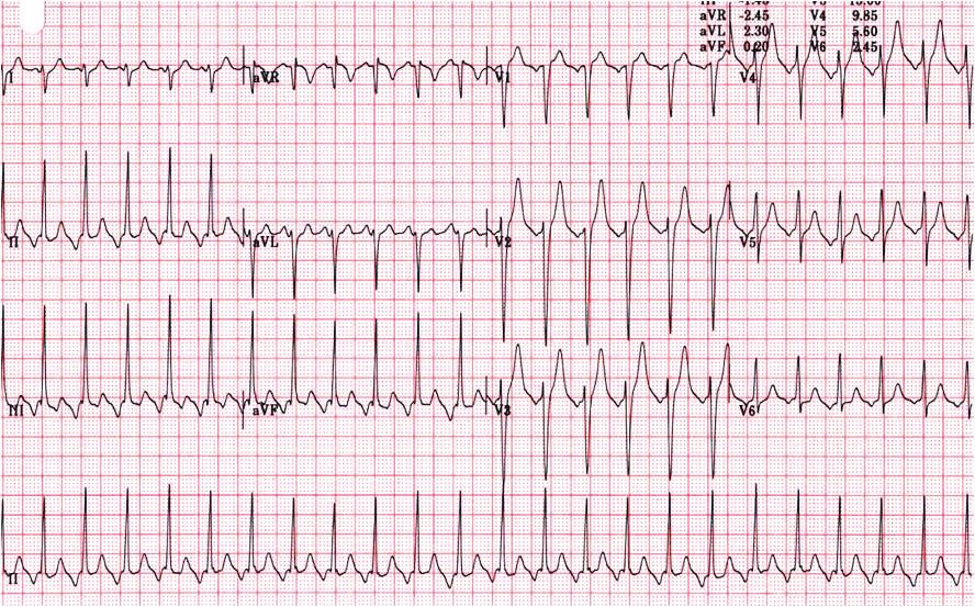 Figure 5. An ECG of atrial tachycardia (AT). This is an example of long RP tachycardia. Obvious negative P waves are observed in lead II, III, and avf.