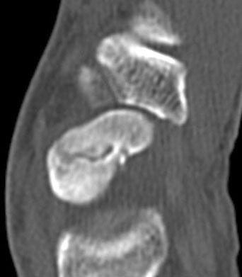 (C) Postoperative 12 months posteroanterior radiograph of the wrist shows bony union and a volarly inserted