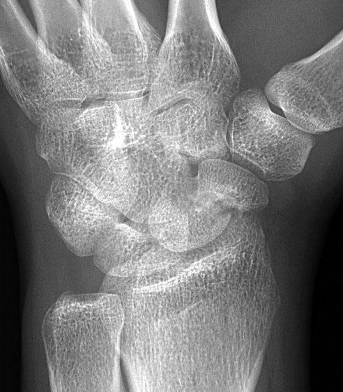 (B) CT shows a gap at the scaphoid waist.