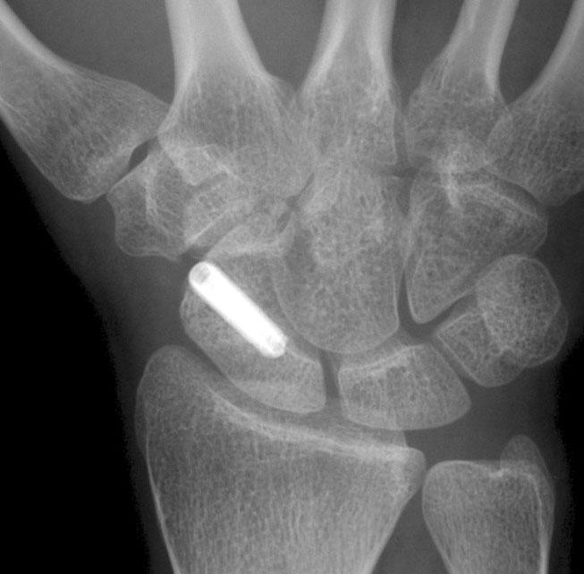 screw. 원위 요골 골절과 동반된 한 예에서 Acutrak 나사 대신 1,1 mm K-강선 두 개를 삽입하였다.