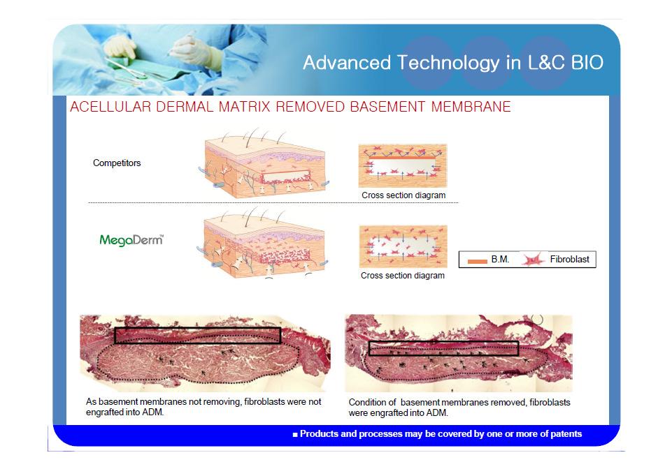 L&C BIO as a professional skin processing tissue bank in Korea had developed a special technology to remove some antigen, which can induce inflammation or immunologic rejection to produce allograft