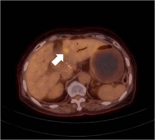 김태균외 6 인 68 A B Fig. 1. (A) PET-CT shows focal increased FDG uptake in a region of liver, S4(maxSUV: 3.7). (Arrow) (B) Lesion that seemed to metastasis in PET-CT was well ablated.