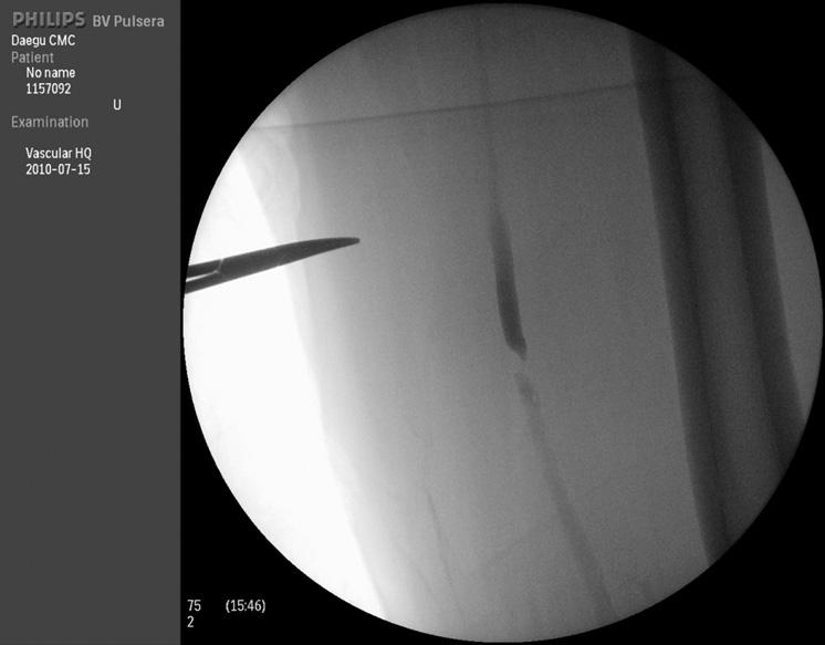 86 대한혈관외과학회지 : 제 26 권제 2 호 2010 Fig. 2. Angiogram shows tight stenosis in left superficial femoral artery (right). After atherectomy was done with SilverHawk (EV3) the lumen was patent.