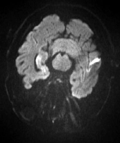 강희진 김지현 이정화등 C D Figure 1. MRI and EEG findings in patient 1.