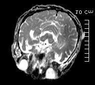 강희진 김지현 이정화등 Figure 5. MRI and EEG findings in patient 5.