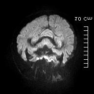 : EEG reveals periodic lateralized epileptiform discharges (PLEDs) in the left hemisphere. 6개월후각각 MRI 를재시행하였을때이병변은모든영상에서사라져경련과관련된변화로판단되었다 (Figure 1C, D).
