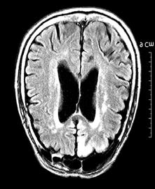 우측으로머리와눈의편위가있고우측팔다리의강직성경련을보이는부분발작이지속되고좌측이마엽간질파 (epileptiform discharges) 가관찰되었던환자 4에서는환자 1과같이좌측이마엽과마루엽피질 (parietal cortex) 에국한된고강도신호가관찰되었으나조영증강소견은없었다 (Figure 4).