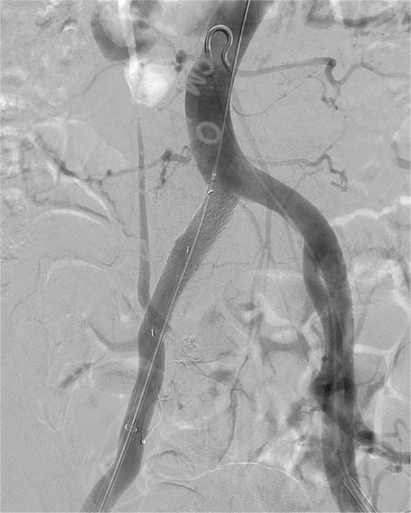 Angiographic image shows an aneurysm involving right internal iliac artery. B.