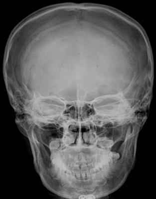 Skull PA Lambdoid suture Frontal sinus : MSP 필름. IOML 필름. 1) 일반적검사 : Nasion. 다리쪽 15 도. 2) Frontal bone : Nasion. 수직입사.