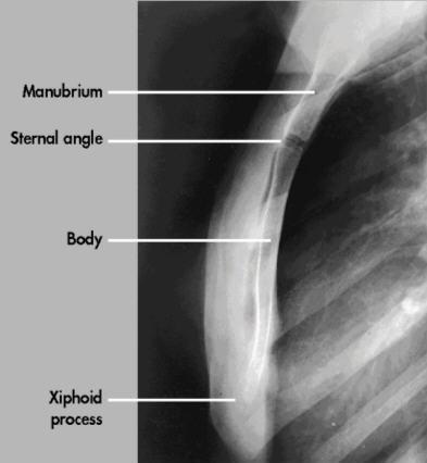 Sternum Lateral : True Lateral.