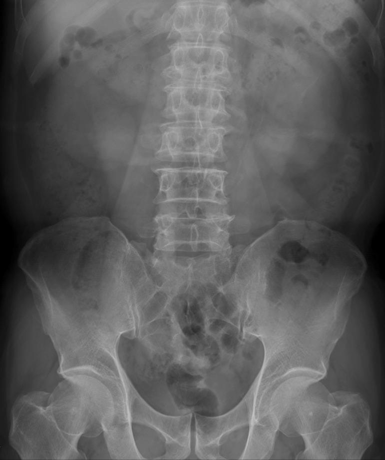 KUB (Kidney, Ureters, Bladder) Kidney : Supine.