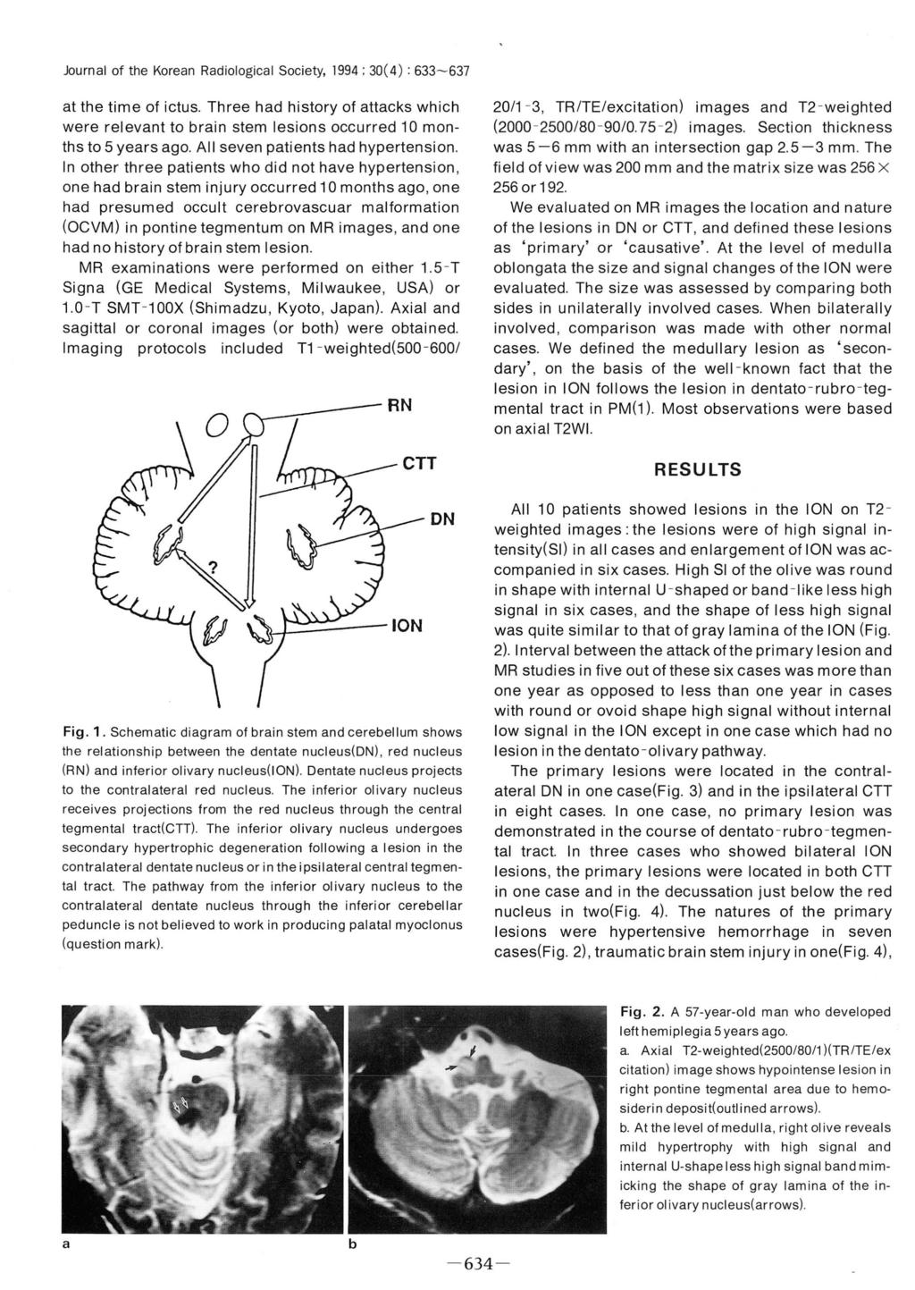 Journal of the Korean Radiological Society, 1994 : 30(4) : 633-637 at the time of ictus. Three had history of attacks which were relevant to brain stem lesions occurred 10 months to 5 years ago.