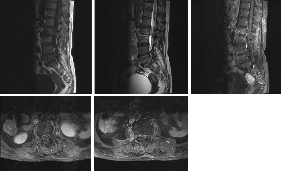 - Taeeun Kim, et al. H. influenzae vertebral osteomyelitis - A B C D E Figure 1. Magnetic resonance (MR) images obtained in the case patient.