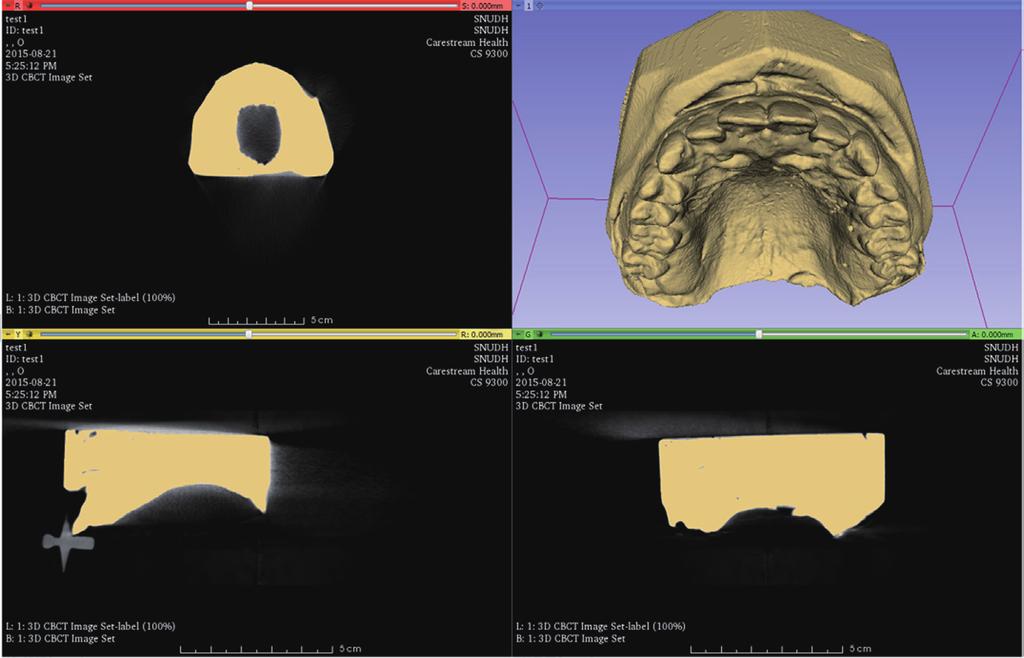 Comparison of digital models generated from three-dimensional optical scanner and cone beam computed tomography 에서시도되어왔고특히교정영역에서의활용가능성은여러연구에서확인되었다.