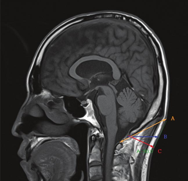 MRI 를 통한 풍부혈 (GV 16 ) 의 안전 자침 깊이에 대한 연구 1) 선정기준 1 Brain MRI 또는 C-spine MRI 영상자료가등록된환자 2 Sagittal view 영상에서대후두공의후방모서리 (Posterior edge of the foramen magnum), 뇌경막 (Cerebral dura mater), 환추 (Atlas),