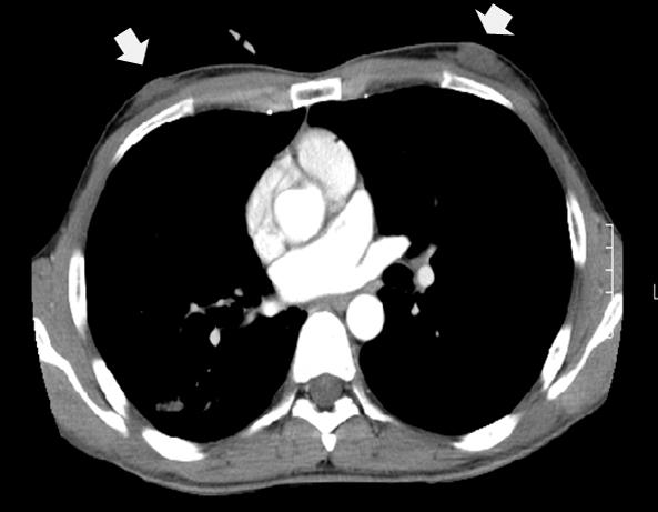 Tuberculosis and Respiratory Diseases Vol. 65. No. 4, Oct. 2008 Figure 1. Chest PA and enhanced Chest CT scan. (A) Multiple ill defined patchy and nodular densities in the BULF.