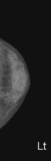 Breast ultrasonography.