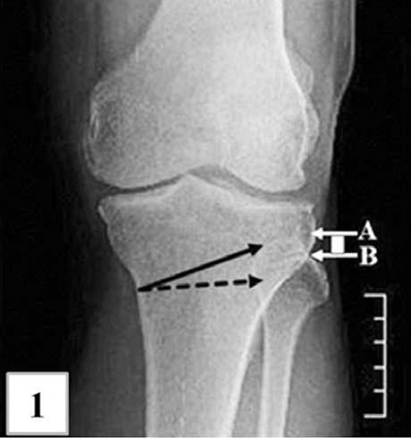 Knee Arthroscopy & Osteotomy Fig. 3.