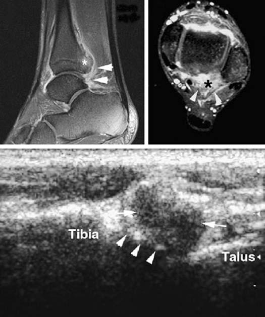 Posterior Impingement 후방충돌증후군은발목의반복된또는강제적인족저굴곡에의해원위경골후방과종골후상방사이조직의압박에의해발생하는데, lateral talar process (Stieda