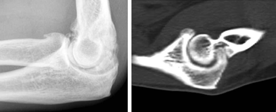 Upper Extremity Arthroscopy Fig. 1. 주관절단순방사선사진과 CT 사진에서전방및후방의골극 (osteophyte) 들을관찰할수있다. 관절경수술 (arthroscopic treatment) 전신마취하에측와위위치 (lateral decubitus) 에서시행하는것이보통이며지혈대를사용하여출혈을줄이는것이좋다.