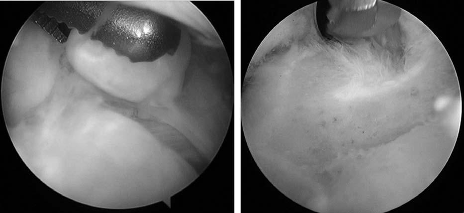 제 2 회관절경수술심포지엄 요골와, 구상돌기와및구상골기순으로 burr 또는 osteotome을이용하여시행한다. 구상돌기쪽골극을제거할때는전외측관절경구에서보면서근위전내측에서기구가들어오는것이수월하다. 이때시야를좋게하기위해서근위전외측관절낭구를통해 retractor를이용할수있다. 제거할골극와정상피질골과의경계는구분이가능하며술전 CT를통한정보를이용하면도움이된다.