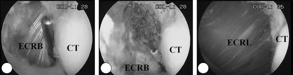 (Arrow indicates capitellar cartilage margin and dotted line indicates upper border of ECRB tendon. CT: Capitellum) 단요수근신건의기시부는관절외 (extraarticular) 구조물이므로전외측삽입구로 3.5 mm 절삭기를삽입한후관절막을절제해야관찰할수있다 (Fig.