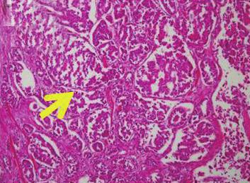 6. Microscopic findings of pathologic confirmed invasive ductal carcinomas arising in intraductal