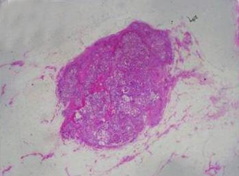 Invasive ductal carcinoma arising in intraductal papilloma (biopsy proven malignancy,