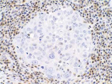 Immunohistochemical stain for p27 shows nuclear (A), mixed nuclear-cytoplamic (B), cytoplasmic (C) and negative (D) expression in breast