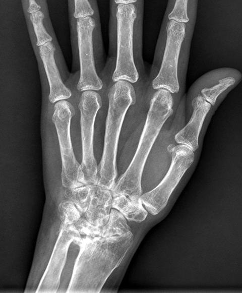 Intraoperative finding of 28 year-old female with 4 th and 5 th extensor tendon ruptures due to rheumatoid arthritis.