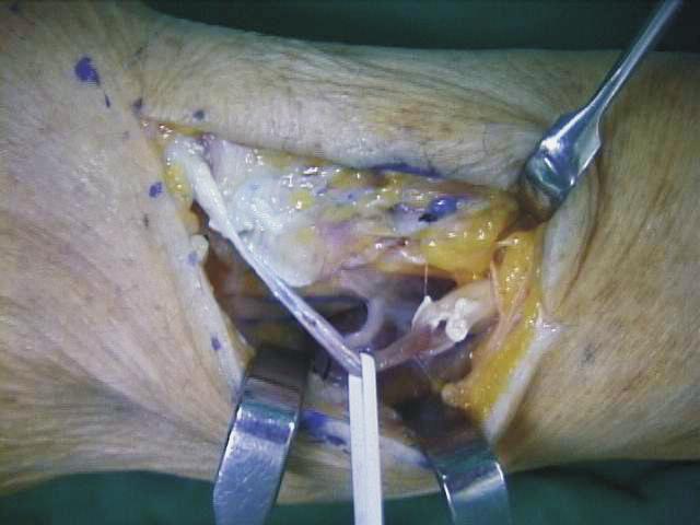 (C) Extensor indicis proprius tendon was obtained.