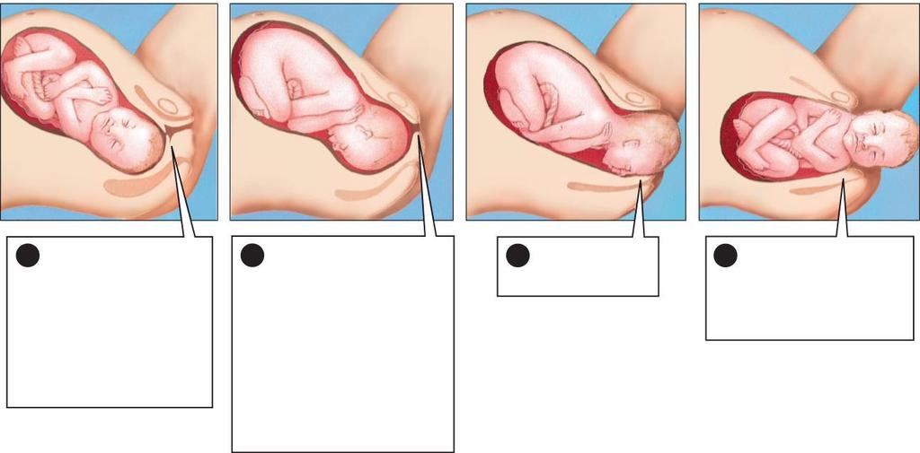 1 The baby orients 2 The cervix dilates head downward, completely to 10 facing the mother s centimeters (almost side; the cervix 4 inches wide), and begins to thin and the baby s head expand in