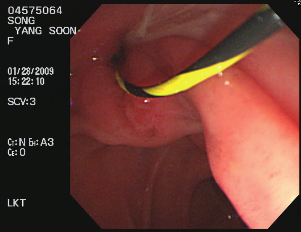 2013 gastroenterology Winter School 9 ENBD (7 Fr) insertion,