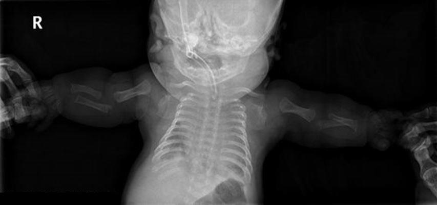 46 Platyspondylic Lethal Skeletal Dysplasia, Torrance Figure 2. Collagen, type II, alpha 1 (COL2A1) analysis shows nonsense mutation in the encoded C-propeptide region of COL2A1, c.4335g>a (p.