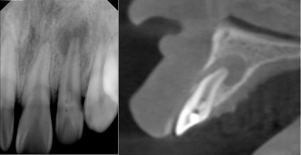 Classification of invaginated teeth by Oehlers (1957). 12. (sinus tract). CBCT Oehlers Type II (Fig 2). open apex.