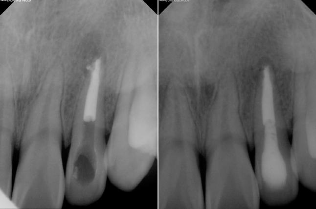 Lee et al. Endodontic treatment of dens invaginatus Figure 3.