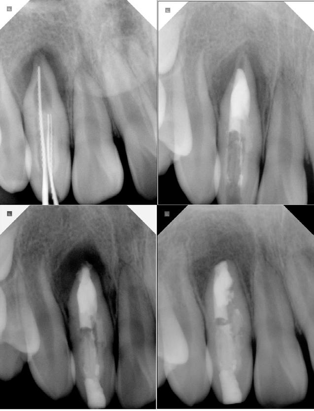 JOURNAL OF KOREAN ACADEMY OF ADVANCED GENERAL DENTISTRY Figure 5. Periapical radiographs of working length determination, root canal filling, apicoectomy and 12 months follow-up visit. 12.,,, 1. 13.