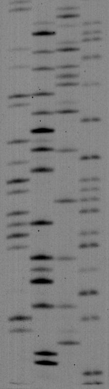 Sequencing result of PIGA gene, showing a mutation of 25 bp deletion of CDs 409-417 : Case 7 G A T C T T A T T C A