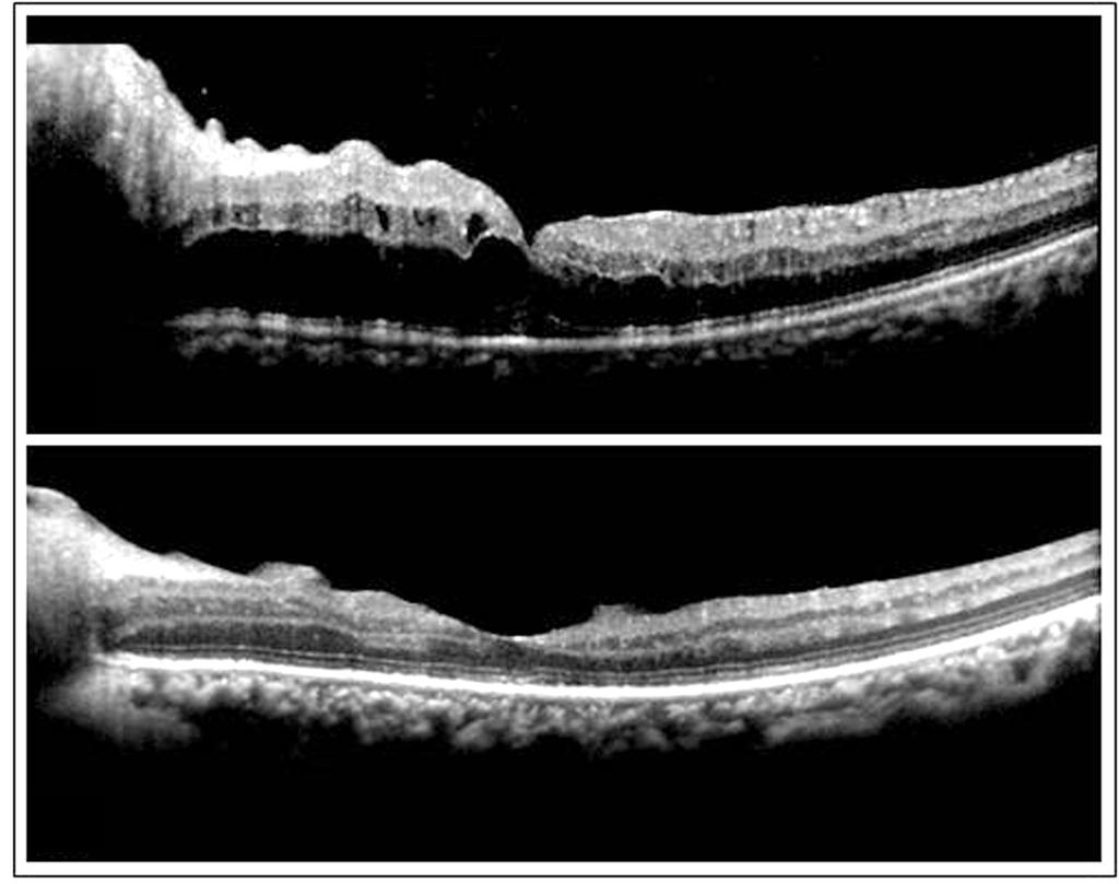 - 대한안과학회지 2013 년제 54 권제 8 호 - Figure 3. () SD-OCT showed hyporeflective subfoveal space and macular edema, which continued as the optic disc swelling in the left eye at patient s first visit.