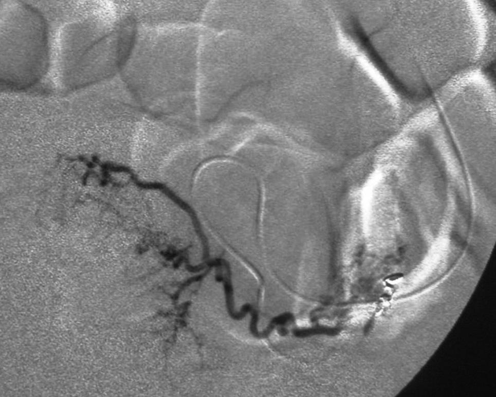 Tuboovarian collateral angiogram shows large tuboovarian collateral(arrow)