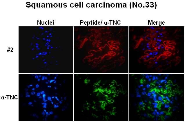 ( 그림 7) Specific detection TNC by the biotin-peptide #2 to lung cancer patient tissues 7.