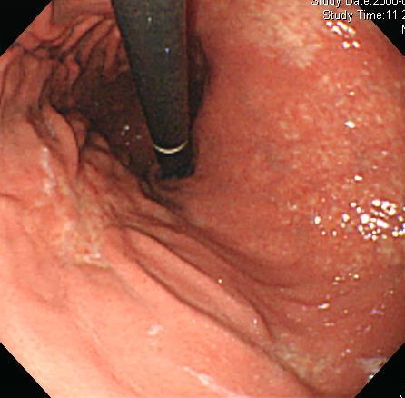 Bone marrow involvement - lymphoid aggregate, CD20(+)