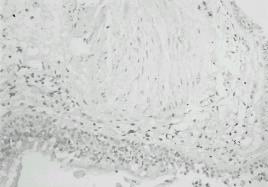 Immunohistochemical staining of T GF 1 in airway mocosa of TDI- induced asthmatic patients. A.