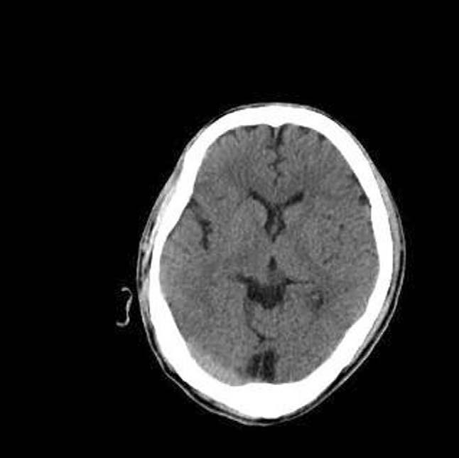 Brain CT (axial view). Normal gyri and ventricle is noted. There is no infarction or hemorrhage 정맥으로투여하였고, 이후내원 1시간이후시행한동맥혈가스분석상 ph 7.301, PaO 2 358 mmhg, PaCO 2 22.2 mmhg, HCO 3-14.0 meq/l, SaO 2 97.