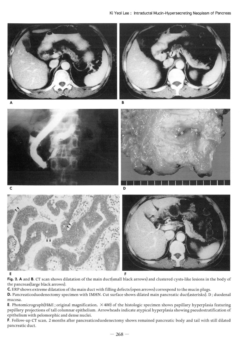 KiYe 이 Lee: Intraductal Mucin 쉬 ypersecreting Neoplasm of Pancreas A B c D E F Fig. 2. A and B.