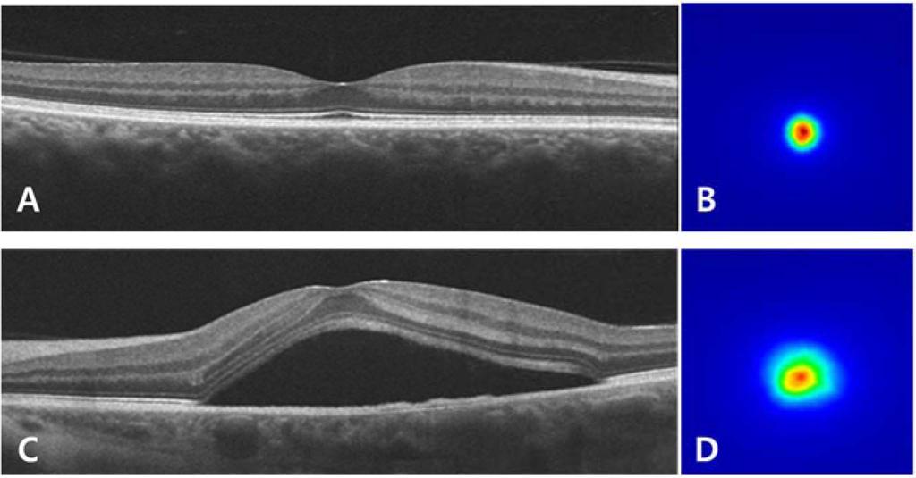 282 Jong Kil Choi, Kyung Min Lee, Heesung Kim, So Ra Kim, and Mijung Park Fig. 1. Analysis of normal eye and central serous chorioretinopathy. A. OCT image through the fovea in normal eye, B.